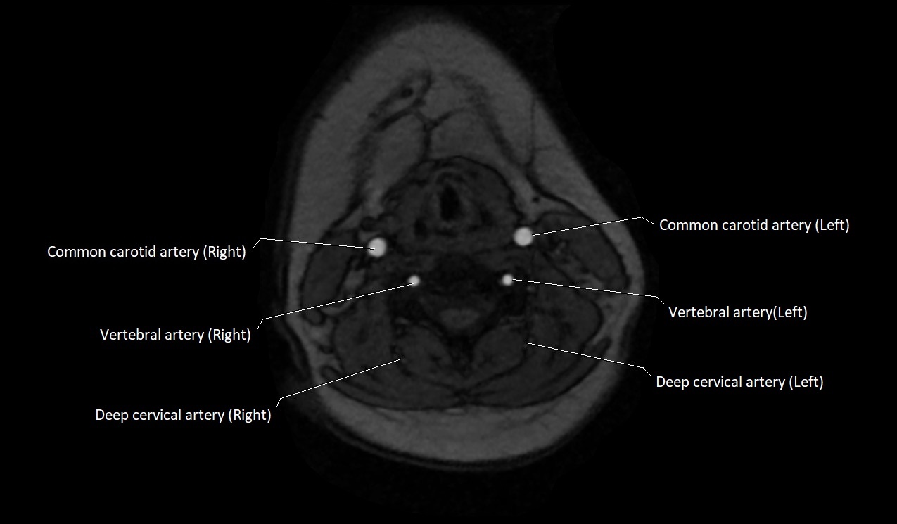 Carotid artery anatomy axial 3T image 36.jpg
